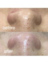 サロン ド ソワン(salon de soin)/毛穴エクストラクション