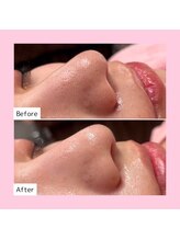 ホワイトラボ ライカム前店(White labo)/【施術例】毛穴洗浄ピーリング