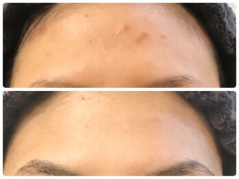 ラウン 京都(ROUN')/約半年の施術ビフォーアフター