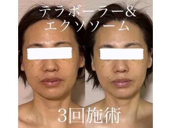 エクレクティック(ECLECTIC)/小顔/若見えフェイシャル