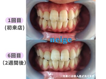 ネージュ(neige)/20代前半/女性/紅茶1日10杯以上