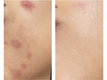 ウー 上熊本(WOO)の写真/【本気のニキビケア・肌荒れ改善】剥離なし＆しみない次世代針ハーブピーリングで自分史上最高のツヤ肌へ