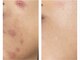 ウー 上熊本(WOO)の写真/【本気のニキビケア・肌荒れ改善】剥離なし＆しみない次世代針ハーブピーリングで自分史上最高のツヤ肌へ