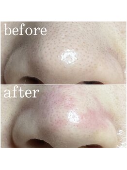 ティーツリー 名古屋 桜山(Tea Tree)/少し赤みが残りますが