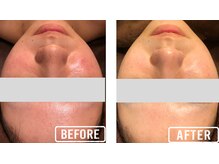 ビビ(VIVI)/ララピール症例★赤ら顔・敏感肌