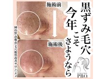 エメ(Aimer)/最新毛穴ケア