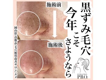 エメ(Aimer)/最新毛穴ケア