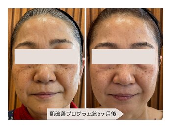 ユーブルーム(youbloom)/肌改善プログラム6ヶ月後!