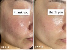 リコ(Lico)の雰囲気(赤みの出やすい敏感肌の方もお待ちしています/コンシーラー卒業)