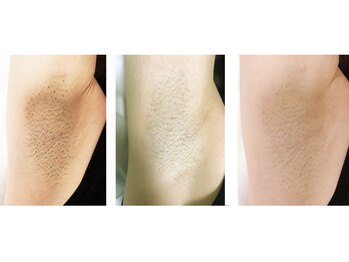 カワル(KAWARU)/わき脱毛