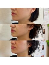 筋膜リリース整体院 喜楽/レッドショット＆小顔調整施術