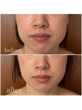 アールイー(Re:)/たるみ予防