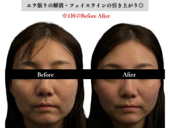 アロエベル(aloe Belle)/Before After（1回施術）