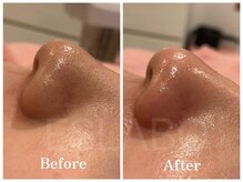 エスラボオオサカ 梅田(エスラボOSAKA)/毛穴洗浄大阪/アクアピール大阪