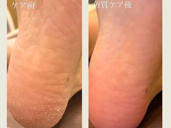 ユープラス(YU+)/角質ケア