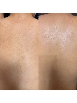 【ハーブピーリング/毛穴洗浄/小顔リフト】total beauty salon mayahime 大宮店/お背中のハーブピーリング