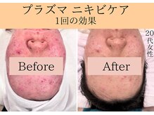 エトワール(etoile)/天王寺あべのでニキビ肌荒れ改善