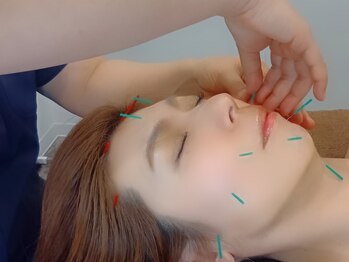 ブルースターの写真/他店で改善しなかったお悩みも◎美容鍼灸で一時的な変化を持続へ♪