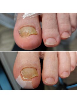 爪切り屋 足楽/陥入爪に