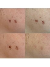 ルコア ドゥ(rucor doux)/シミケア予防綺麗にし放題☆