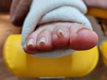 爪切り屋 足楽/押しつぶされて巻く爪【before】