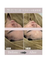 サロンフロム つくば店(Salon From)/◆肌育ララピールフェイシャル◆