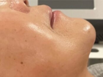 エミュ(e'mu)の写真/【結果重視サロン】大人女性から当店人気！県内希少マシン《HIRFWAVE pro》でシワやたるみを改善！