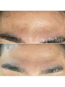 レヴール(reveur)/フェイシャルケア×脱毛