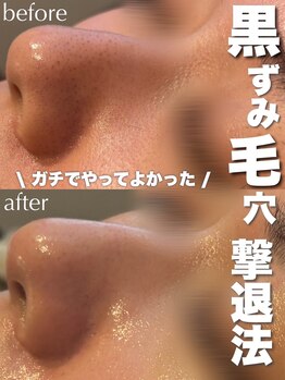 ジェノール 2nd beauty studio 姫路駅前店(JNOEL)/黒ずみ毛穴の撃退法！