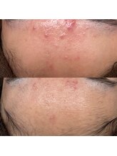 ベリスユイット(BELLIS HUIT)/剥離なしハーブピーリング