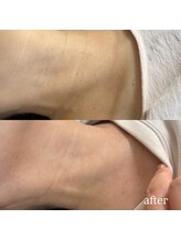 プライベートサロン プース(pousse)/首イボケア