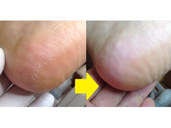 ドクターネイル爪革命 秋津店/かかとの角質ケア