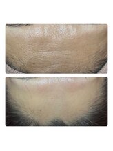 アマラ(Amarra)/1回で額の緊張もとれて艶美額へ