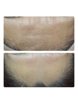 アマラ(Amarra)/1回で額の緊張もとれて艶美額へ