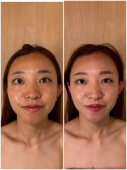 アグレア(Agrea)/頭蓋骨小顔矯正1回の施術♪