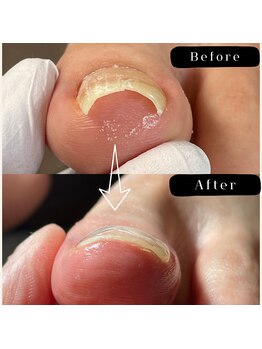 まき爪晴れる/急な痛み