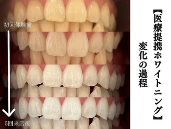 ホワイトニングセンター 長野駅前店/【長野市ホワイトニング】