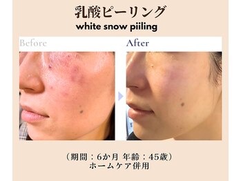 アフロディーテ(Aphrodite)/◆乳酸ピーリング◆