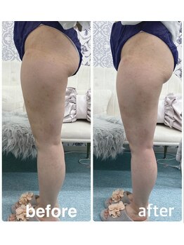 ハロ 南青山(HALO)/脂肪分解スタンプ+ラジオ波