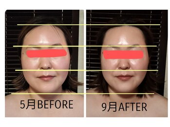 プピレ(pupille)/BEFORE、AFTER写真