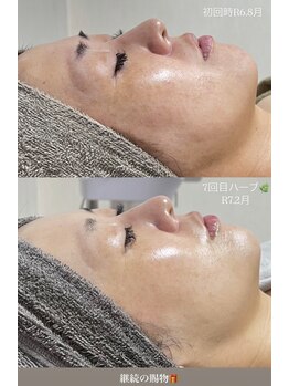 クレヴィー(Creviy)/月イチハーブの肌変化