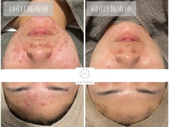 ラヴィオーラ 都島京橋店(La Viora)/ダイヤモンドハーブピーリング