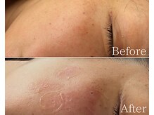 気になる部分をポイントでケアしてお肌をキレイに☆