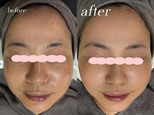 ミウル 天王寺店(miulu)/50代/シミケア照射＋ハーブ4回目