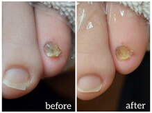 爪切り屋 足楽/お悩み「こゆび爪が小さい！」