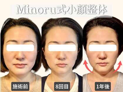 フレキシボディ(FlexiBody)の写真