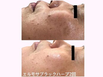 ぷるるんエステの写真/【何をしても変わらなかった方へ】隠す肌から魅せる素肌へ。根本から美しさを引き出す本格ハーブケア