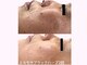 ぷるるんエステの写真/【何をしても変わらなかった方へ】隠す肌から魅せる素肌へ。根本から美しさを引き出す本格ハーブケア