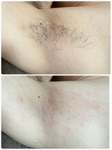 ルーメ(lume)/脱毛30代男性