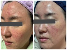 1度の施術で効果を実感◎肌質改善ハーブピーリング